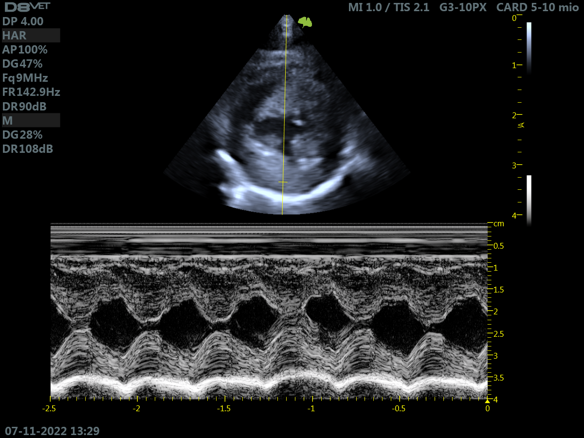 Transient Myocardial Thickening: quando l’ipertrofia è transitoria