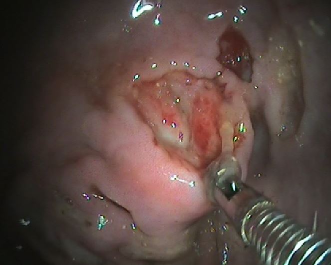 EROSIONE ED ULCERAZIONE GASTRO-DUODENALE NEI CANI EPATOPATICI