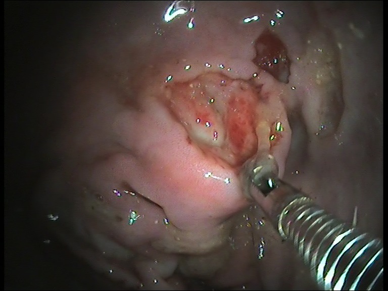 Biopsia endoscopica o a tutto spessore: quale scegliere in gastroenterologia?
