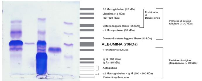 La valutazione qualitativa della proteinuria con SDS-AGE nel paziente nefropatico cronico