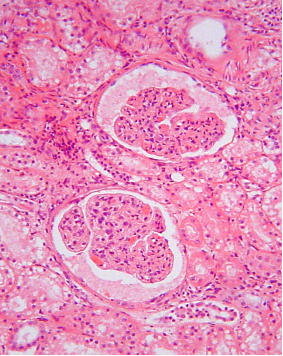 La valutazione quantitativa della proteinuria