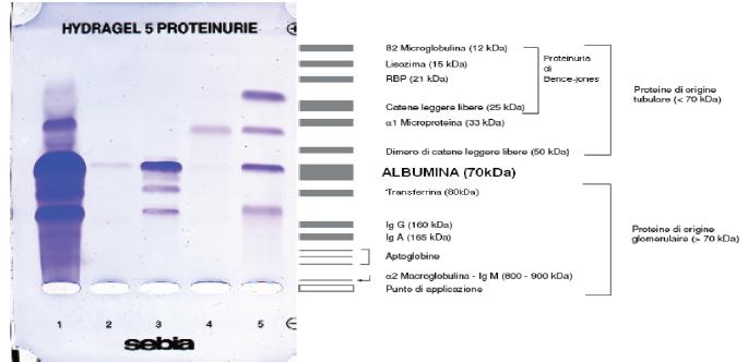 VALUTAZIONE QUALITATIVA DELLE PROTEINE URUNARIE MEDIANTE METODICA SDS-AGE