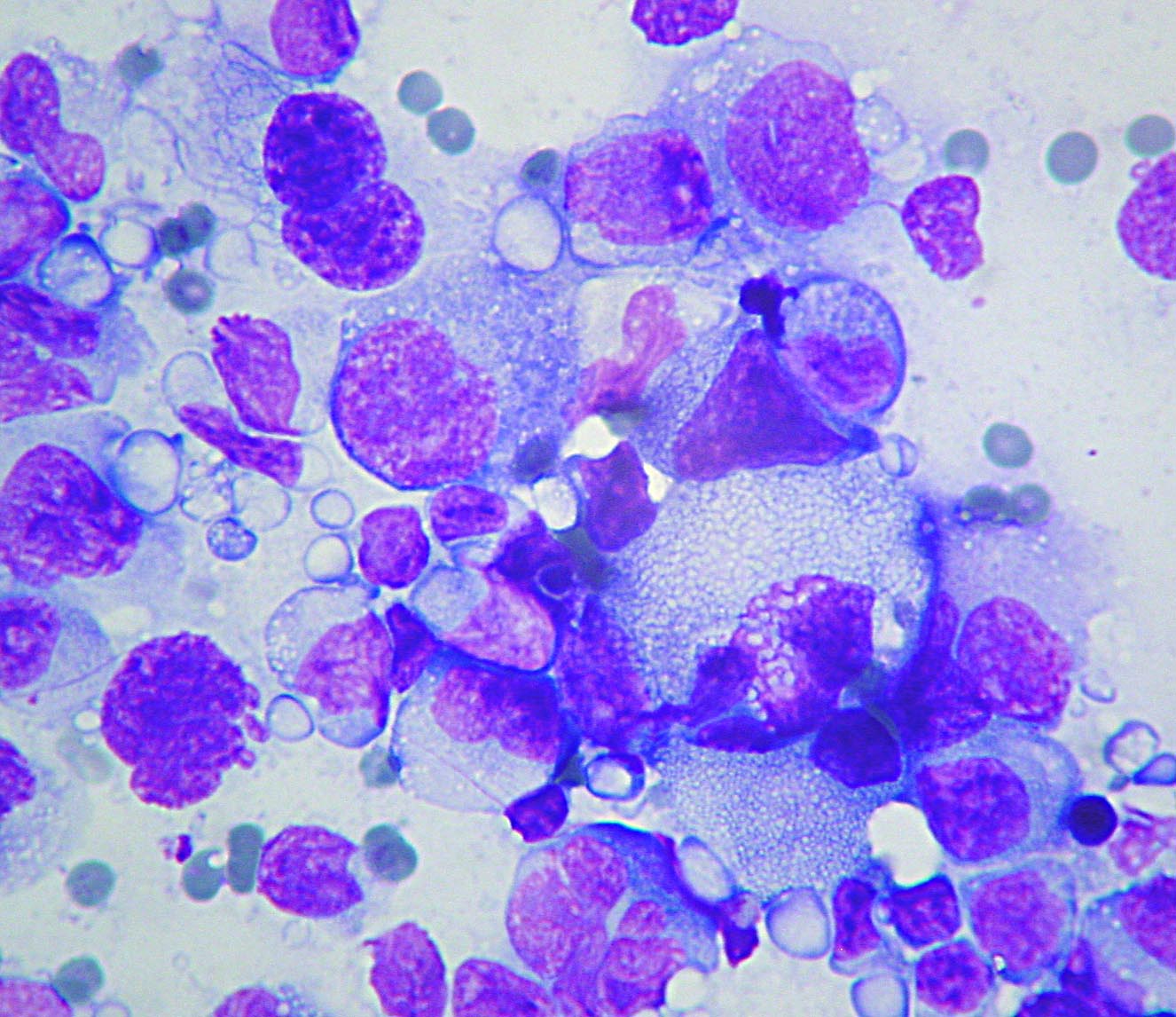 La ricerca delle metastasi linfonodali: quanto è accurata la citologia?